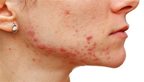 itchy chin and jawline hormonal|hormonal acne on jawline.